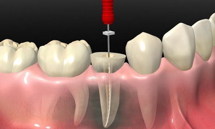 عصب کشی دندان (درمان ریشه دندان)