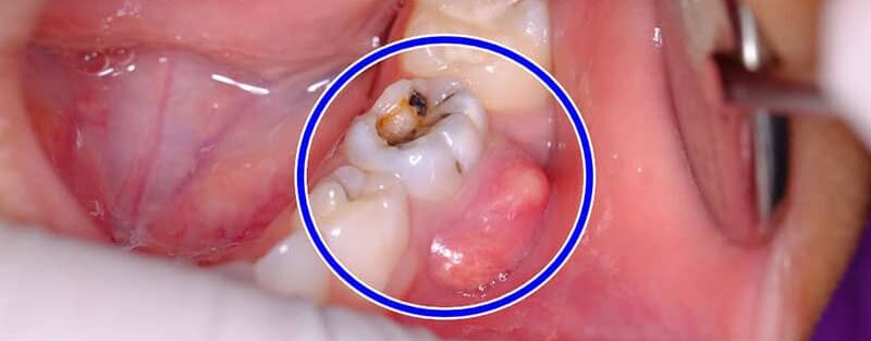 عفونت دندان عصب کشی شده بعد از چند سال