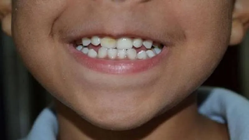 فلوروزیس دندان