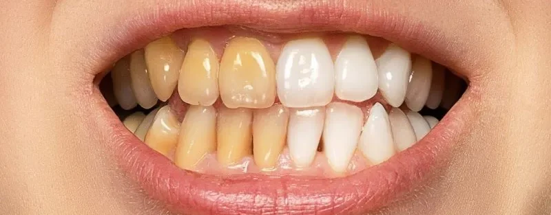 لکه ها و تغییر رنگ دندان ها