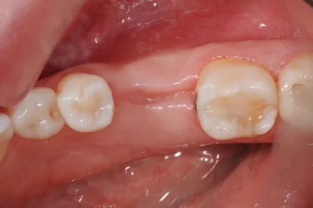 تحلیل لثه بعد از کشیدن دندان ، علائم و نکات مراقبتی