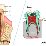 پالپوتومی دندان