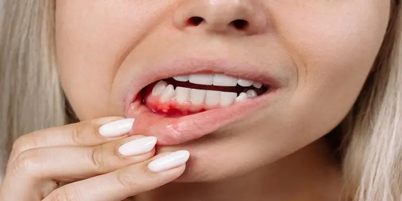 قطع فوری خونریزی دندان با طب سنتی