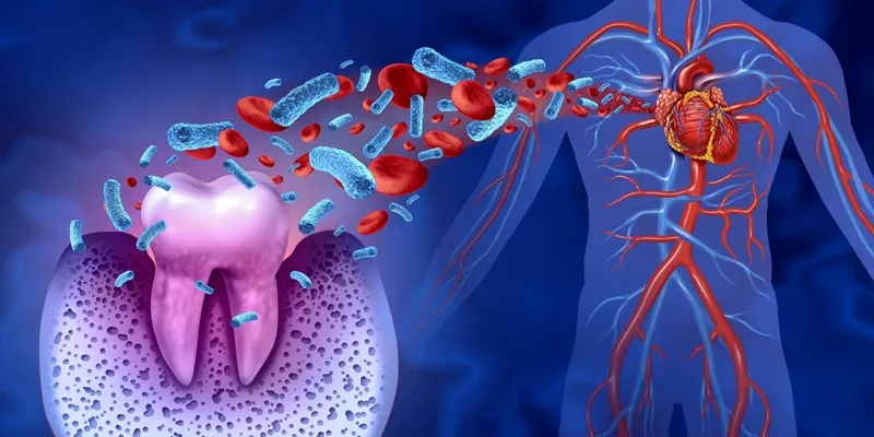 ارتباط میکروب‌ های دهان با گرفتگی عروق
