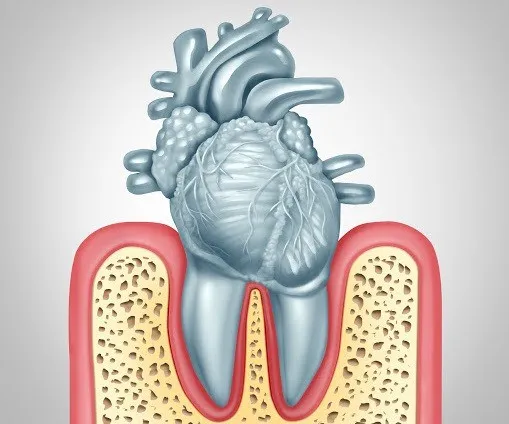 ارتباط میکروب‌ های دهان با گرفتگی عروق